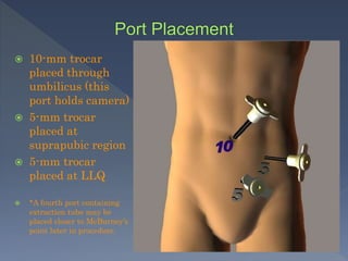  10-mm trocar
placed through
umbilicus (this
port holds camera)
 5-mm trocar
placed at
suprapubic region
 5-mm trocar
placed at LLQ
 *A fourth port containing
extraction tube may be
placed closer to McBurney’s
point later in procedure.
 