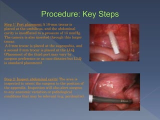 Step 1: Port placement A 10-mm trocar is
placed at the umbilicus, and the abdominal
cavity is insufflated to a pressure of 15 mmHg.
The camera is also inserted through this larger
trocar.
A 5-mm trocar is placed at the suprapubis, and
a second 5-mm trocar is placed at the LLQ.
(Placement of the third port may vary by
surgeon preference or as case dictates but LLQ
is standard placement)
Step 2: Inspect abdominal cavity The area is
inspected to orient the surgeon to the position of
the appendix. Inspection will also alert surgeon
to any anatomic variation or pathological
conditions that may be relevant (e.g. peritonitis).
 