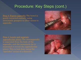 Step 3: Expose appendix The bowel is
gently retracted rostrally using
atraumatic graspers to allow access to
appendix.
Step 4: Locate and separate
appendicular artery The mesoappendix
is separated from the body of the
appendix, and the mesenteric fat is
separated to reveal the appendicular
artery. This is best done using the
“spreader” action of a dissector.
 