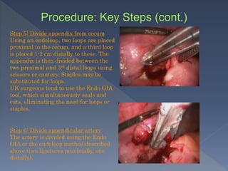 Step 5: Divide appendix from cecum
Using an endoloop, two loops are placed
proximal to the cecum, and a third loop
is placed 1-2 cm distally to these. The
appendix is then divided between the
two proximal and 3rd distal loops using
scissors or cautery. Staples may be
substituted for loops.
UK surgeons tend to use the Endo GIA
tool, which simultaneously seals and
cuts, eliminating the need for loops or
staples.
Step 6: Divide appendicular artery
The artery is divided using the Endo
GIA or the endoloop method described
above (two ligatures proximally, one
distally).
 