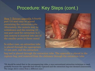 Step 7: Extract appendix A fourth
port (10 mm) may be placed
containing the extraction tube.
Alternately, the camera may be
withdrawn and the existing 10
mm port used for extraction (a 5
mm camera is inserted into one of
the smaller ports in these cases).
In either case, an extraction tube
is placed through the appropriate
10 mm port, and the extraction
bag tool is placed through the extraction tube. The appendix is placed in the
capture bag, and removed from the abdomen through the extraction tube.
*(It should be noted that in the accompanying video, a non-conventional extraction technique is used,
probably because the appendix had already ruptured and the extraction bag was deemed unnecessary.
The image above comes from a different case.)
 