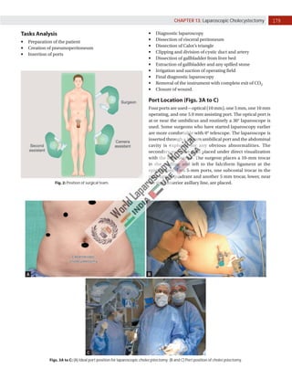 Safety Landmarks in Laparoscopic Cholecystectomy | IntechOpen