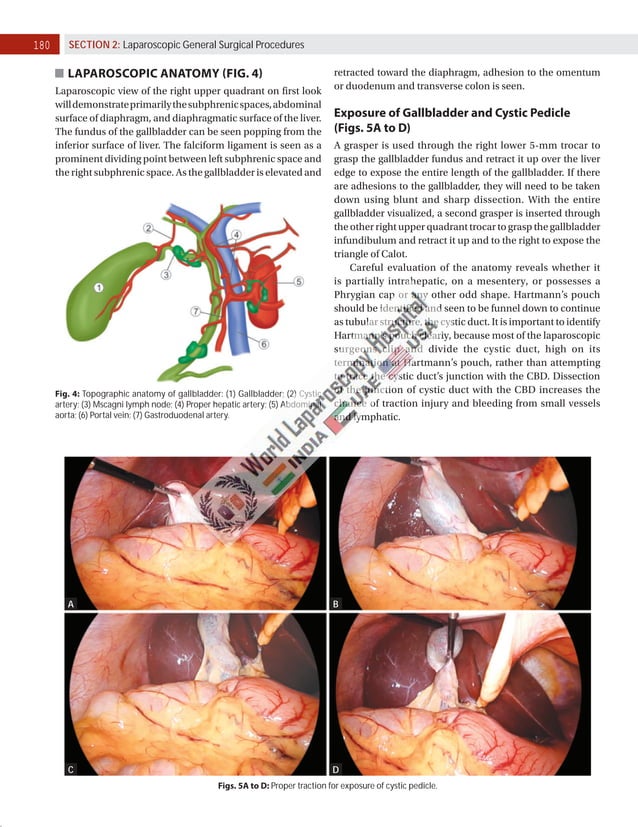 Laparoscopic Cholecystectomy