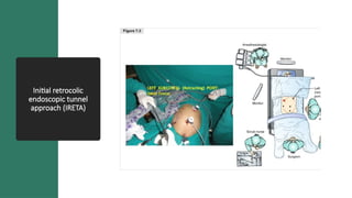 surgical techniques laparoscopic colectomy.pptx