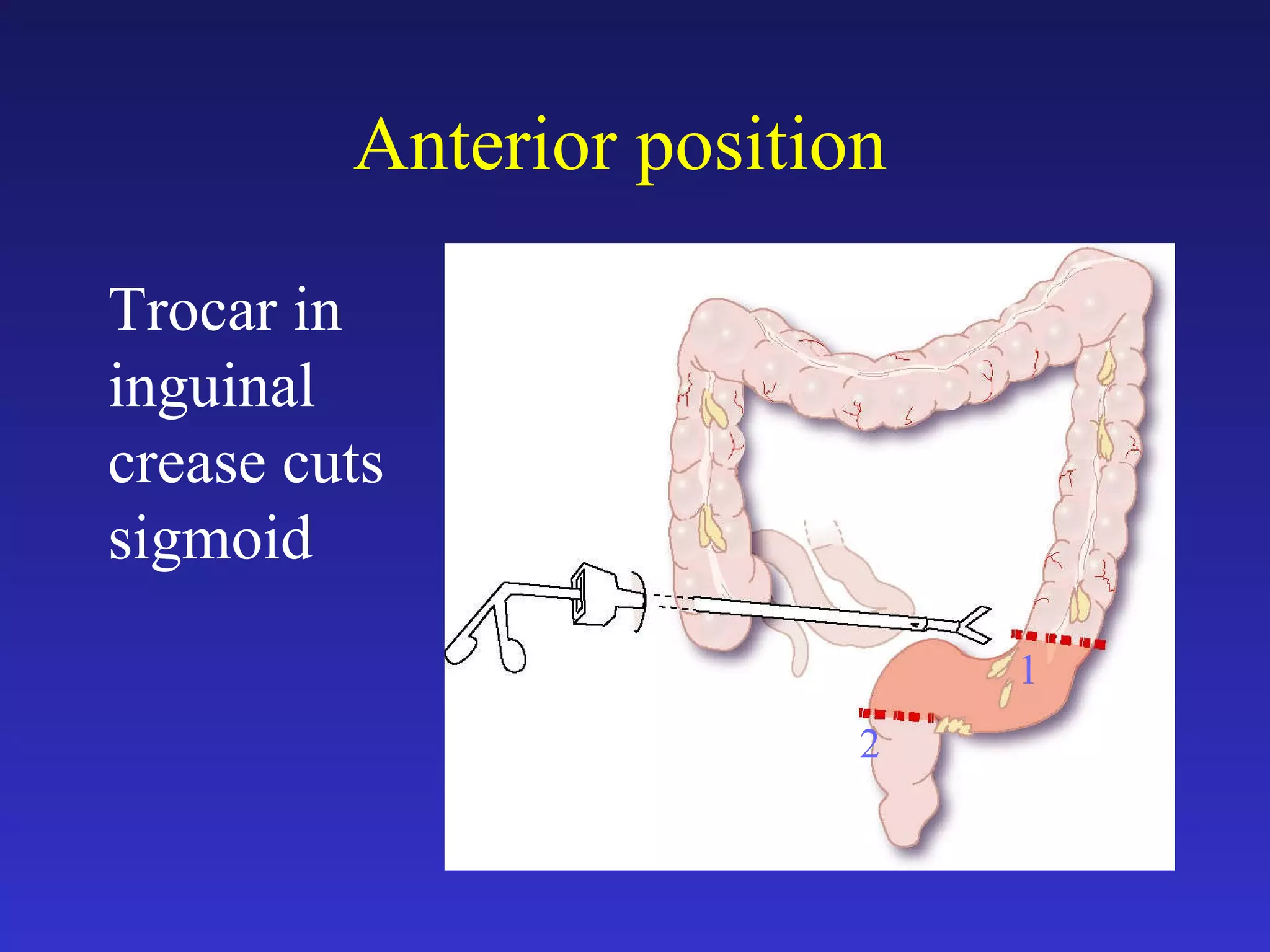 Anterior position   1 2 Trocar in inguinal crease cuts sigmoid 