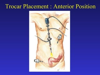 Trocar Placement : Anterior Position 