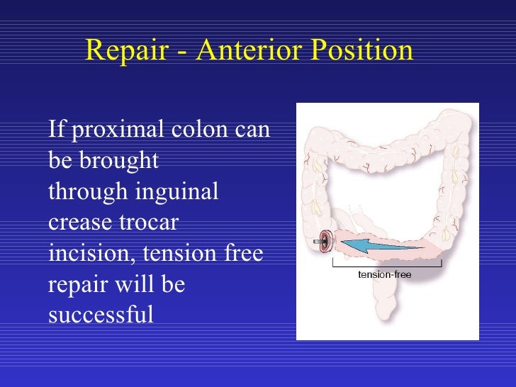 Laparoscopic Colon Resection Anterior Approach