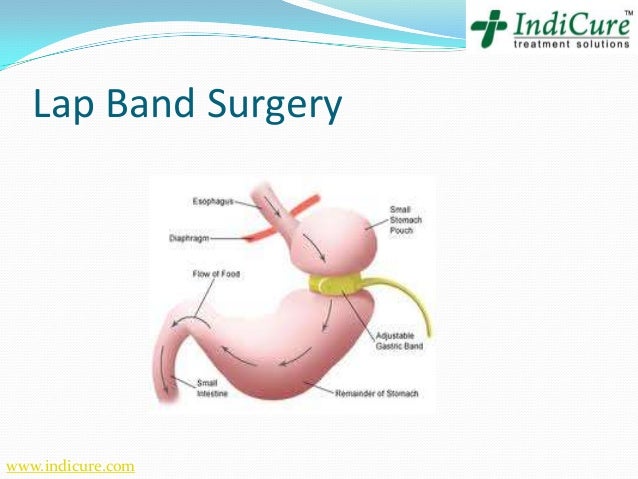 Laparoscopic Gastric Band Surgery In India Cost & Benefits