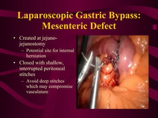 Laparoscopic Gastric Bypass: Mesenteric Defect Created at jejuno-jejunostomy Potential site for internal herniation Closed with shallow, interrupted peritoneal stitches Avoid deep stitches which may compromise vasculature 