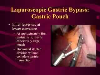 Laparoscopic Gastric Bypass: Gastric Pouch Enter lesser sac at lesser curvature At approximately first gastric vein, avoids excessively large pouch Horizontal stapled division without complete gastric transection 