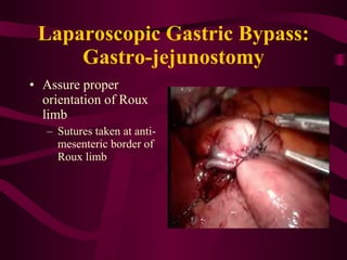 Laparoscopic Gastric Bypass: Gastro-jejunostomy Assure proper orientation of Roux limb Sutures taken at anti-mesenteric border of Roux limb 