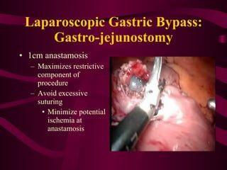 Laparoscopic Gastric Bypass: Gastro-jejunostomy 1cm anastamosis Maximizes restrictive component of procedure Avoid excessive suturing Minimize potential ischemia at anastamosis 