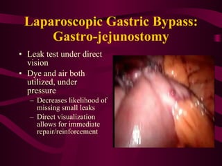 Laparoscopic Gastric Bypass: Gastro-jejunostomy Leak test under direct vision Dye and air both utilized, under pressure Decreases likelihood of missing small leaks Direct visualization allows for immediate repair/reinforcement 