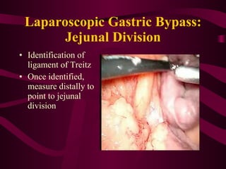Laparoscopic Gastric Bypass: Jejunal Division Identification of ligament of Treitz Once identified, measure distally to point to jejunal division 