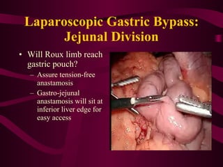 Laparoscopic Gastric Bypass: Jejunal Division Will Roux limb reach gastric pouch? Assure tension-free anastamosis Gastro-jejunal anastamosis will sit at inferior liver edge for easy access 