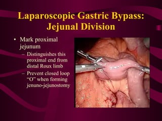 Laparoscopic Gastric Bypass: Jejunal Division Mark proximal jejunum Distinguishes this proximal end from distal Roux limb Prevent closed loop “O” when forming jenuno-jejunostomy 
