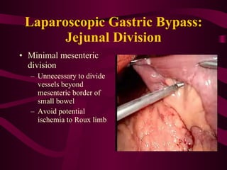 Laparoscopic Gastric Bypass: Jejunal Division Minimal mesenteric division Unnecessary to divide vessels beyond mesenteric border of small bowel Avoid potential ischemia to Roux limb 