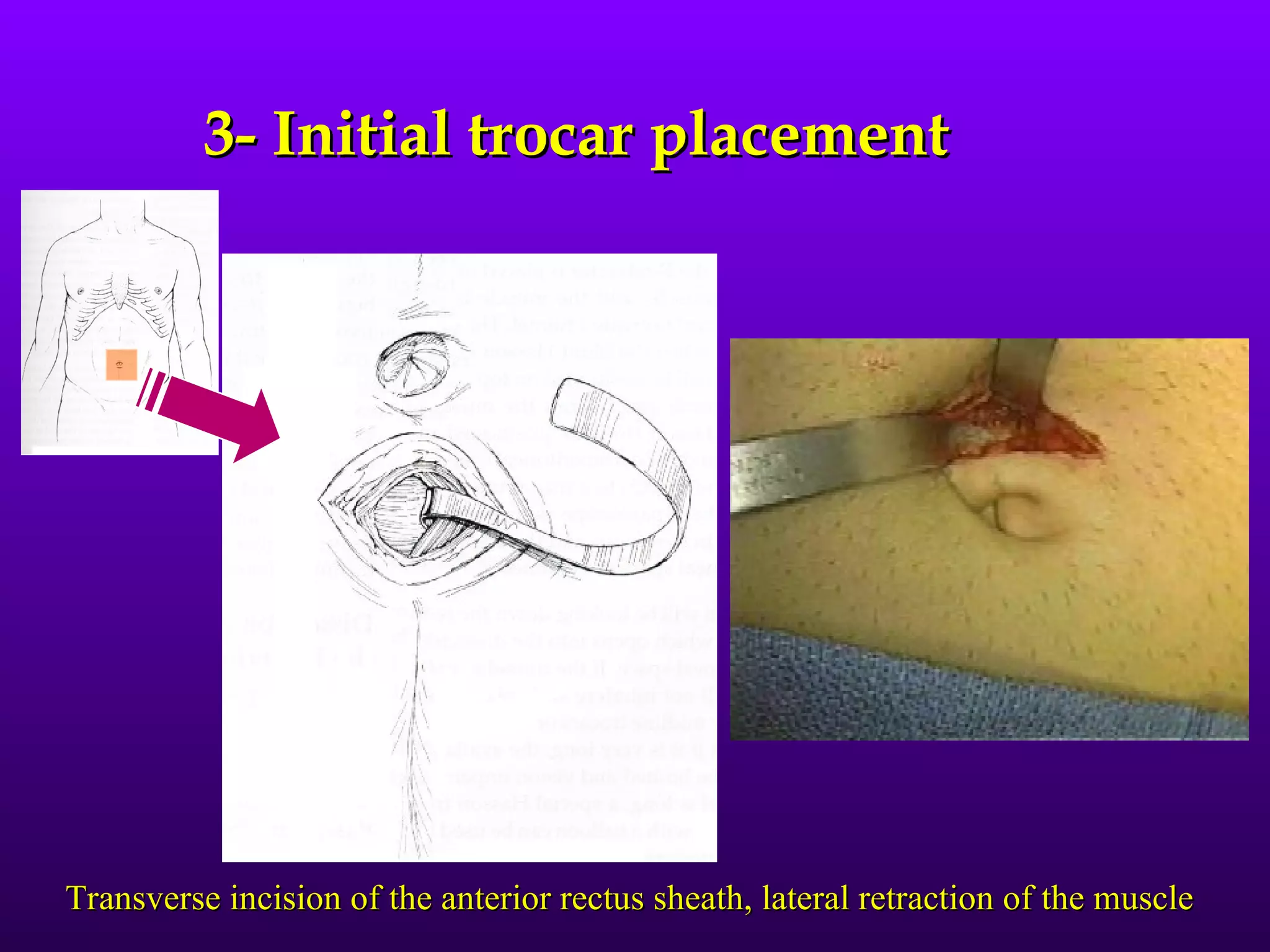 3- Initial trocar placement




Transverse incision of the anterior rectus sheath, lateral retraction of the muscle
 