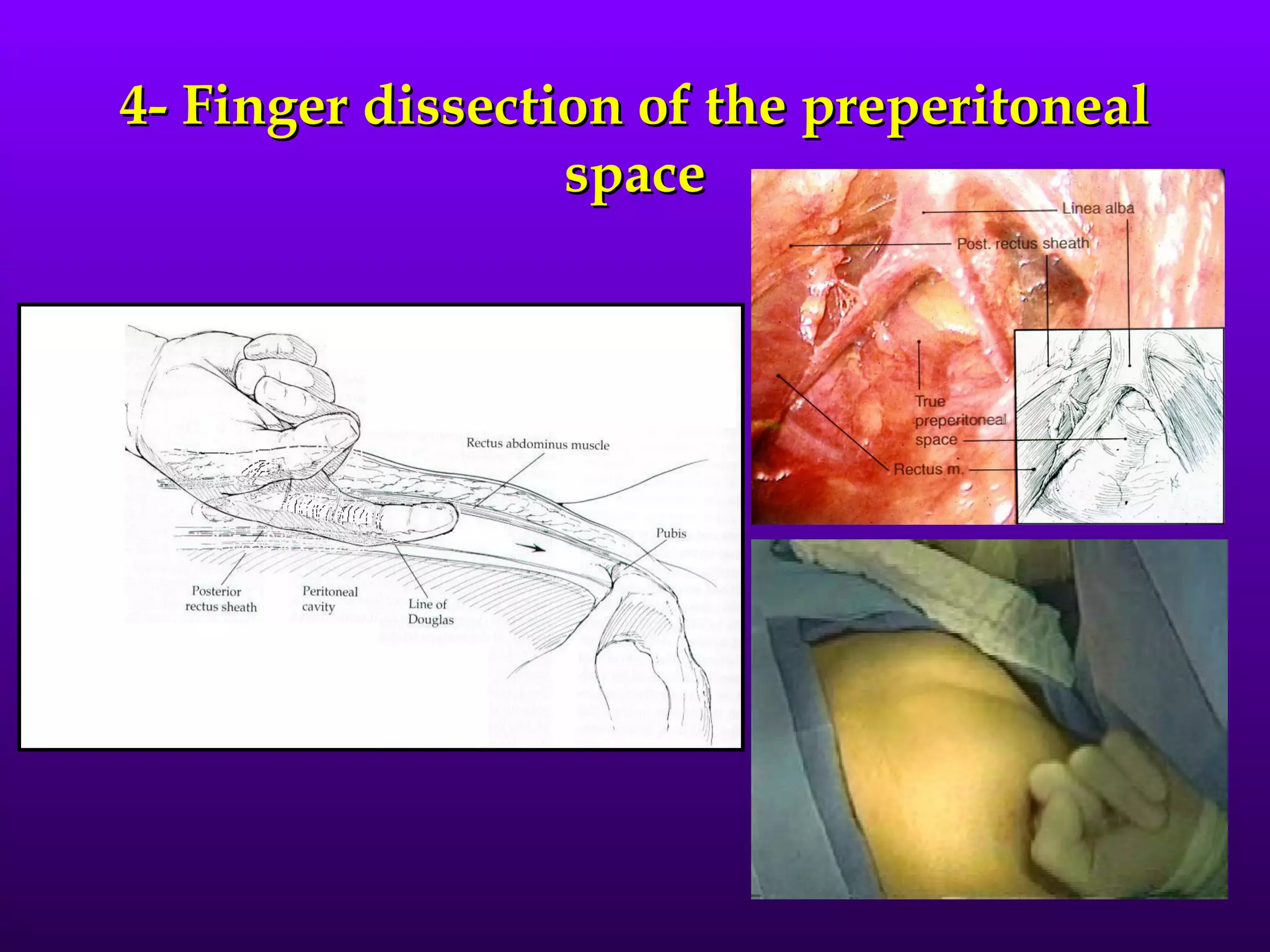 4- Finger dissection of the preperitoneal
                  space
 