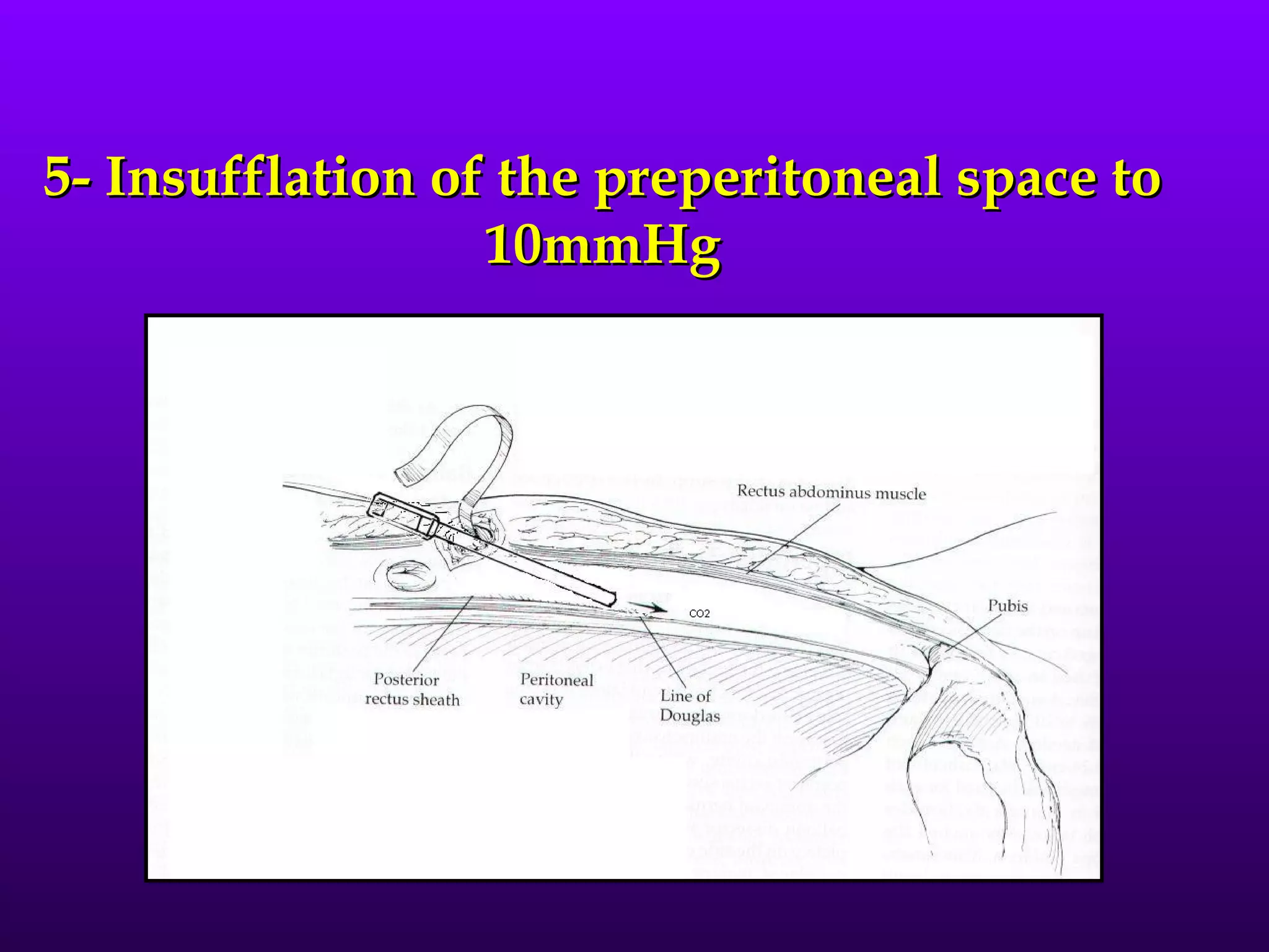 5- Insufflation of the preperitoneal space to
                  10mmHg
 