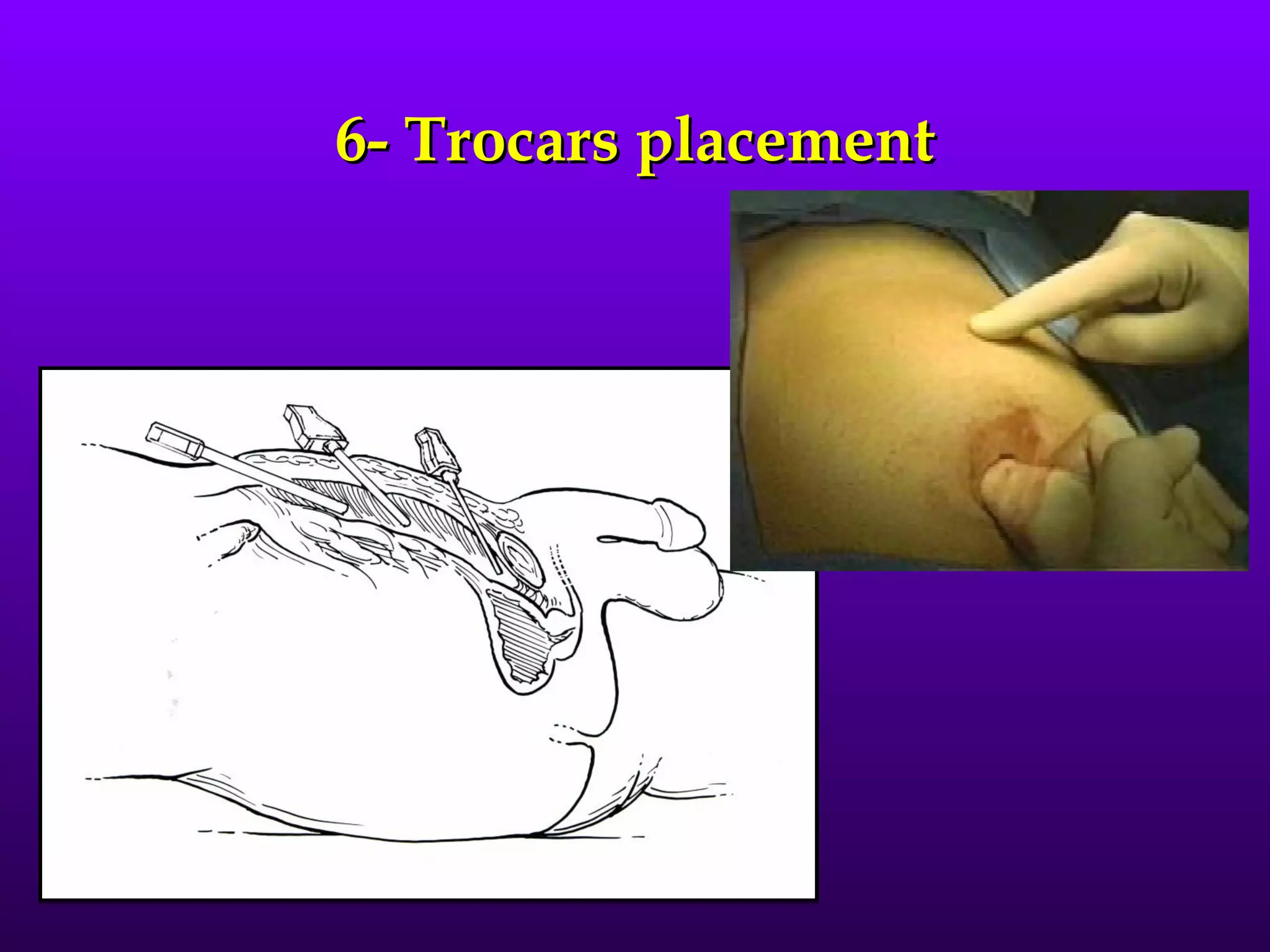 6- Trocars placement
 