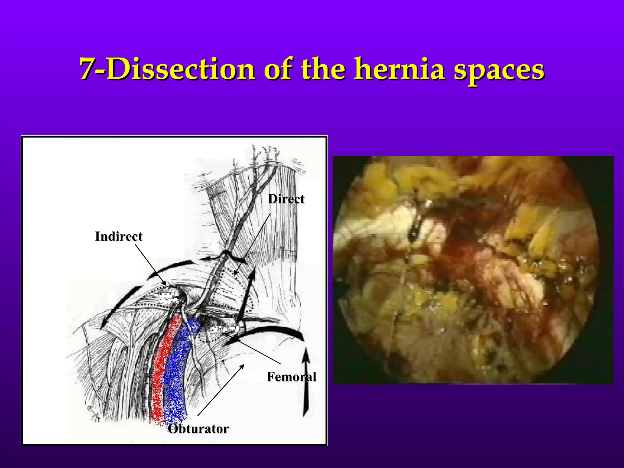 7-Dissection of the hernia spaces


                        Direct

 Indirect




                        Femoral


            Obturator
 