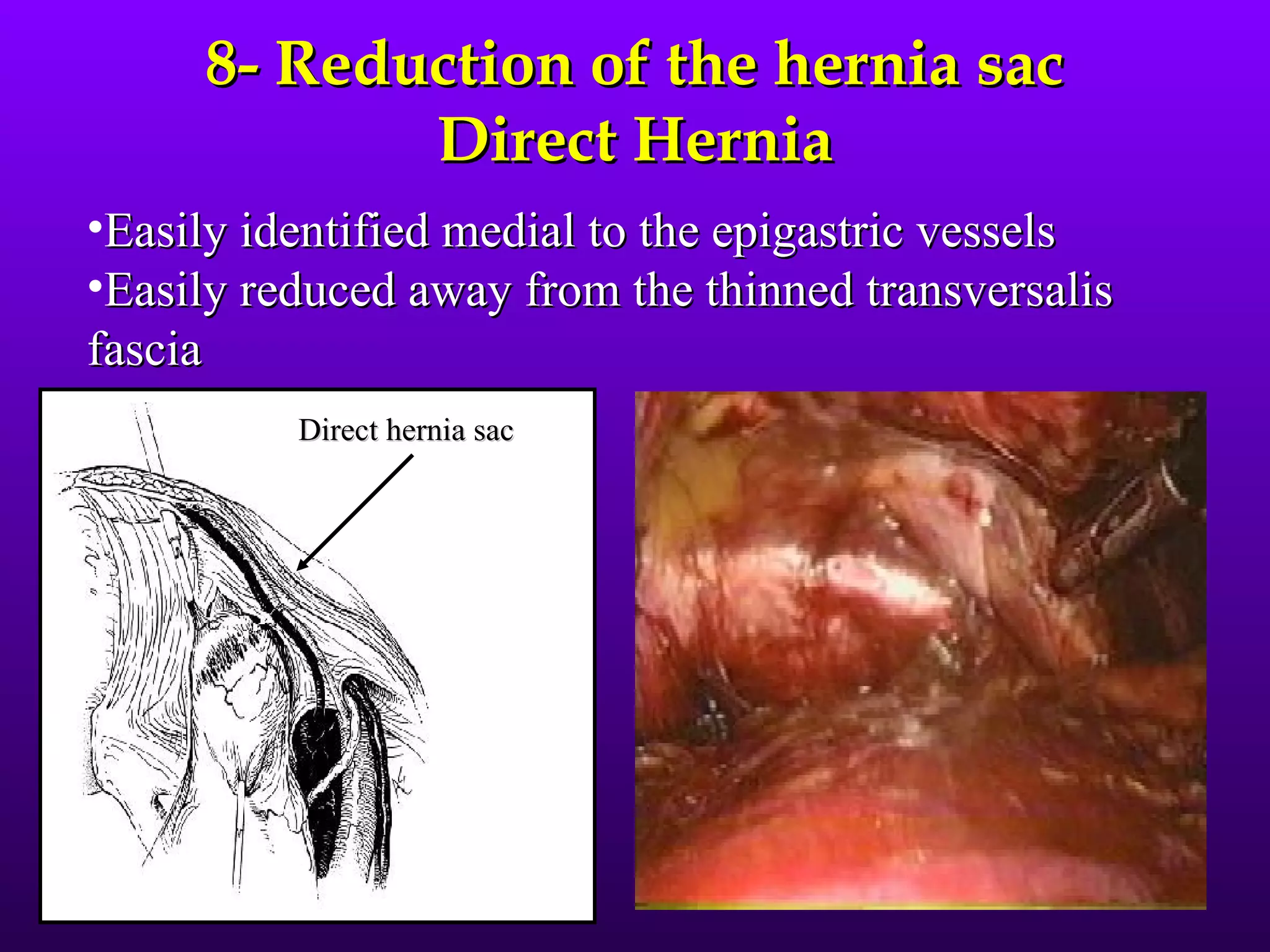 8- Reduction of the hernia sac
            Direct Hernia
•Easily identified medial to the epigastric vessels
•Easily reduced away from the thinned transversalis
fascia
          Direct hernia sac
 