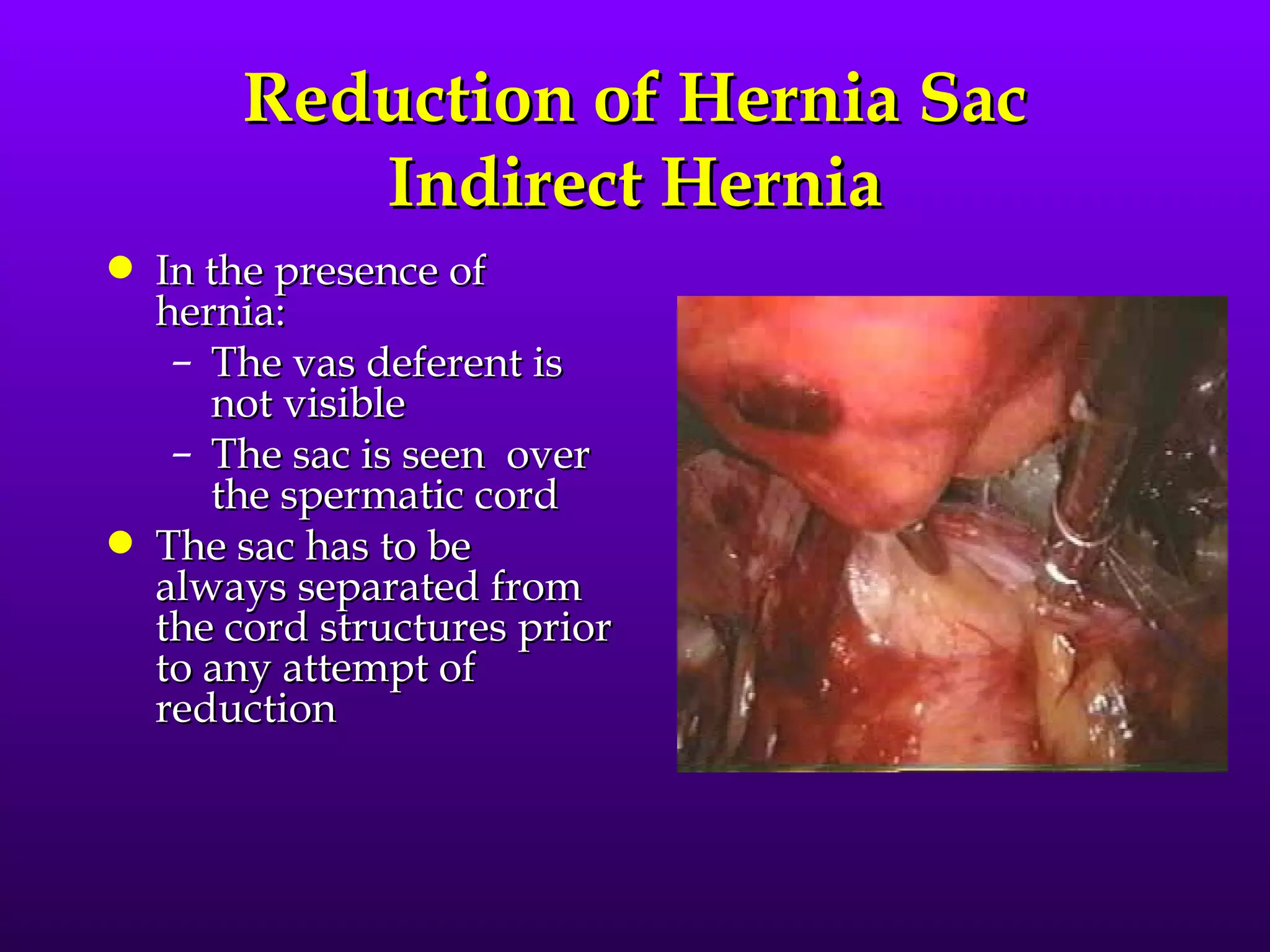 Reduction of Hernia Sac
           Indirect Hernia
q   In the presence of
    hernia:
     – The vas deferent is
       not visible
     – The sac is seen over
       the spermatic cord
q   The sac has to be
    always separated from
    the cord structures prior
    to any attempt of
    reduction
 