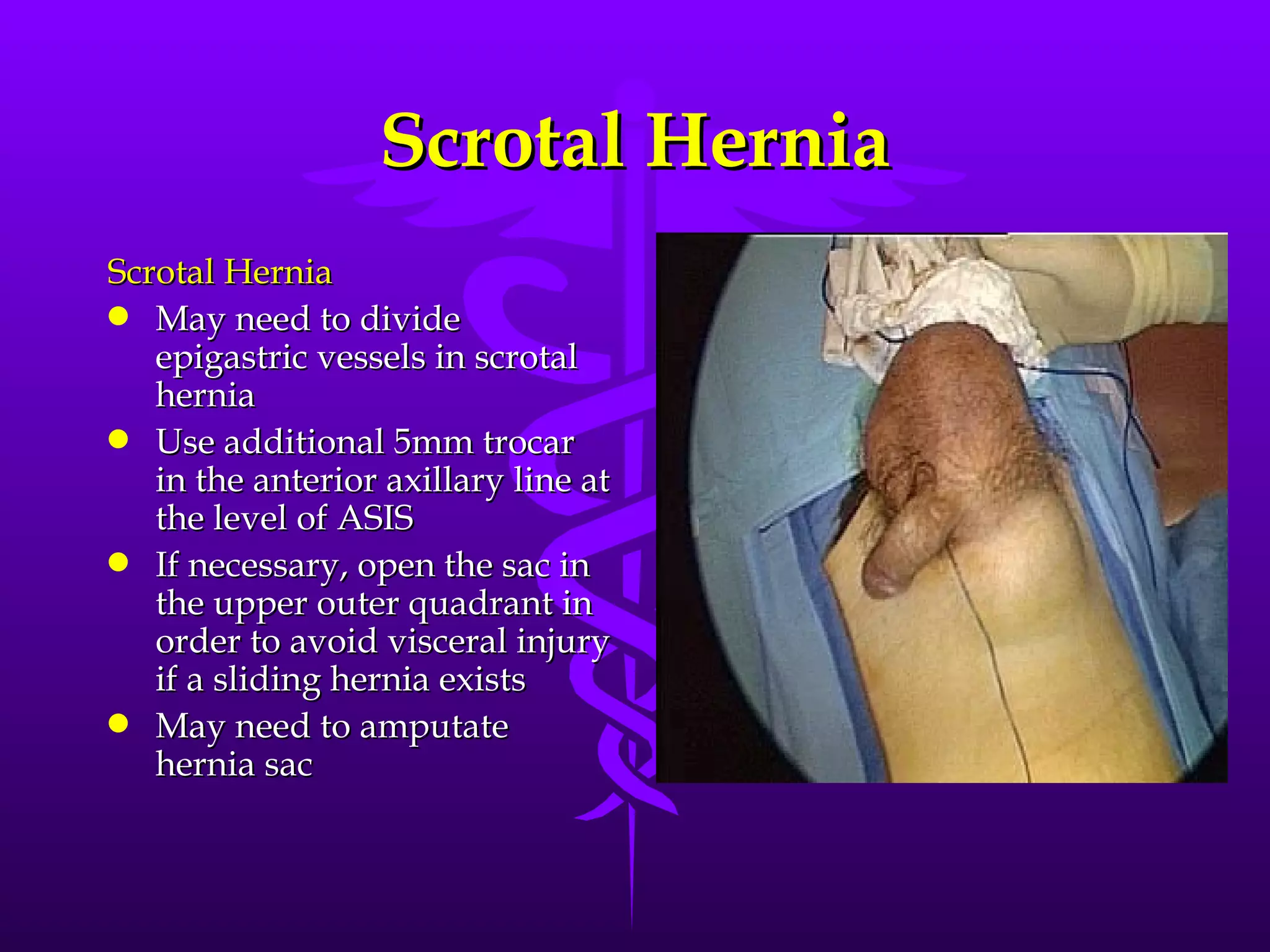 Scrotal Hernia
Scrotal Hernia
q May need to divide
   epigastric vessels in scrotal
   hernia
q Use additional 5mm trocar
   in the anterior axillary line at
   the level of ASIS
q If necessary, open the sac in
   the upper outer quadrant in
   order to avoid visceral injury
   if a sliding hernia exists
q May need to amputate
   hernia sac
 