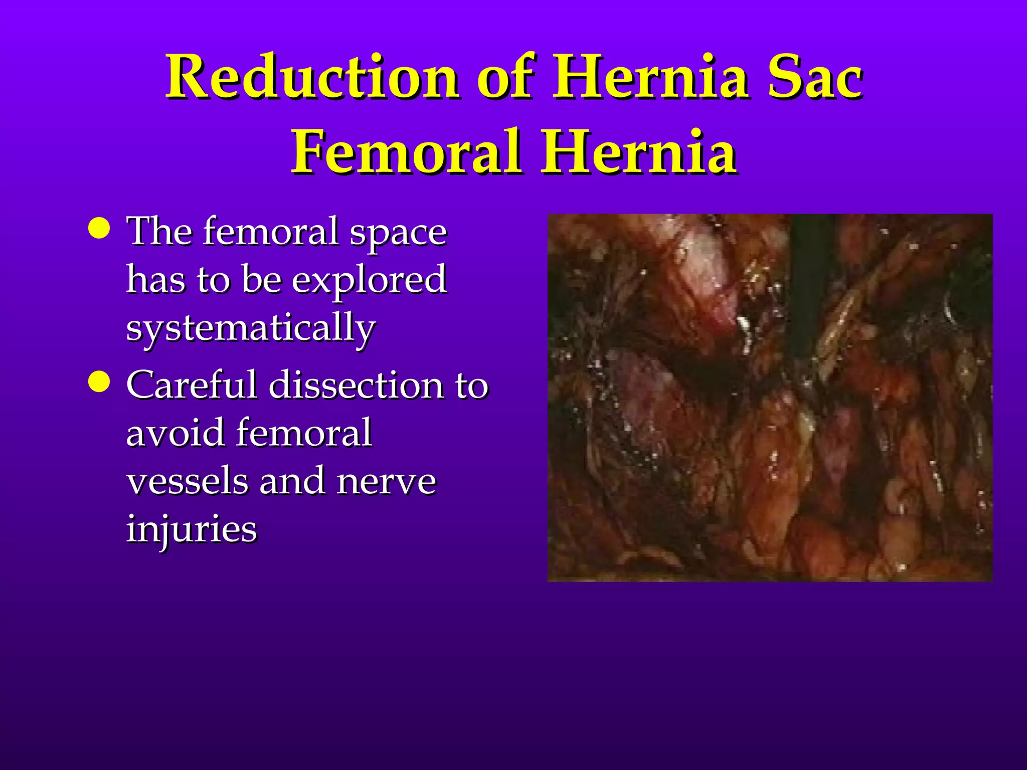 Reduction of Hernia Sac
         Femoral Hernia
q   The femoral space
    has to be explored
    systematically
q   Careful dissection to
    avoid femoral
    vessels and nerve
    injuries
 