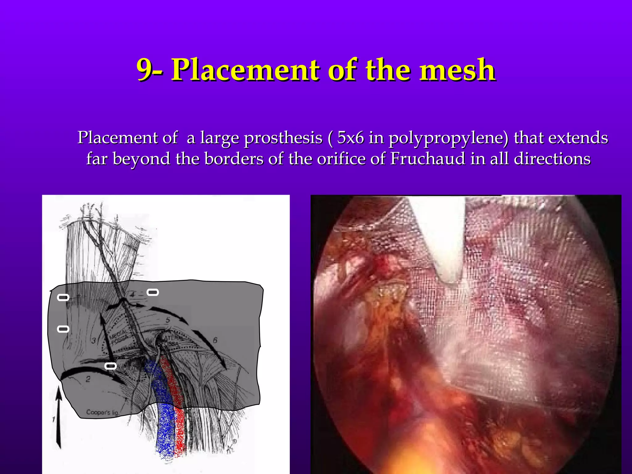 9- Placement of the mesh

Placement of a large prosthesis ( 5x6 in polypropylene) that extends
 far beyond the borders of the orifice of Fruchaud in all directions
 