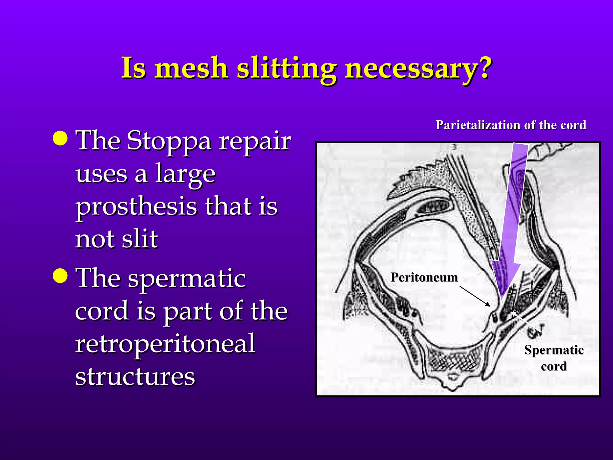 Is mesh slitting necessary?
                              Parietalization of the cord
q The Stoppa repair
  uses a large
  prosthesis that is
  not slit
q The spermatic         Peritoneum

  cord is part of the
  retroperitoneal                            Spermatic
                                               cord
  structures
 