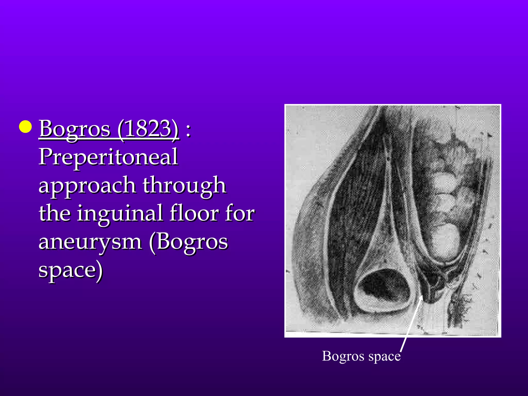 q   Bogros (1823) :
    Preperitoneal
    approach through
    the inguinal floor for
    aneurysm (Bogros
    space)


                             Bogros space
 