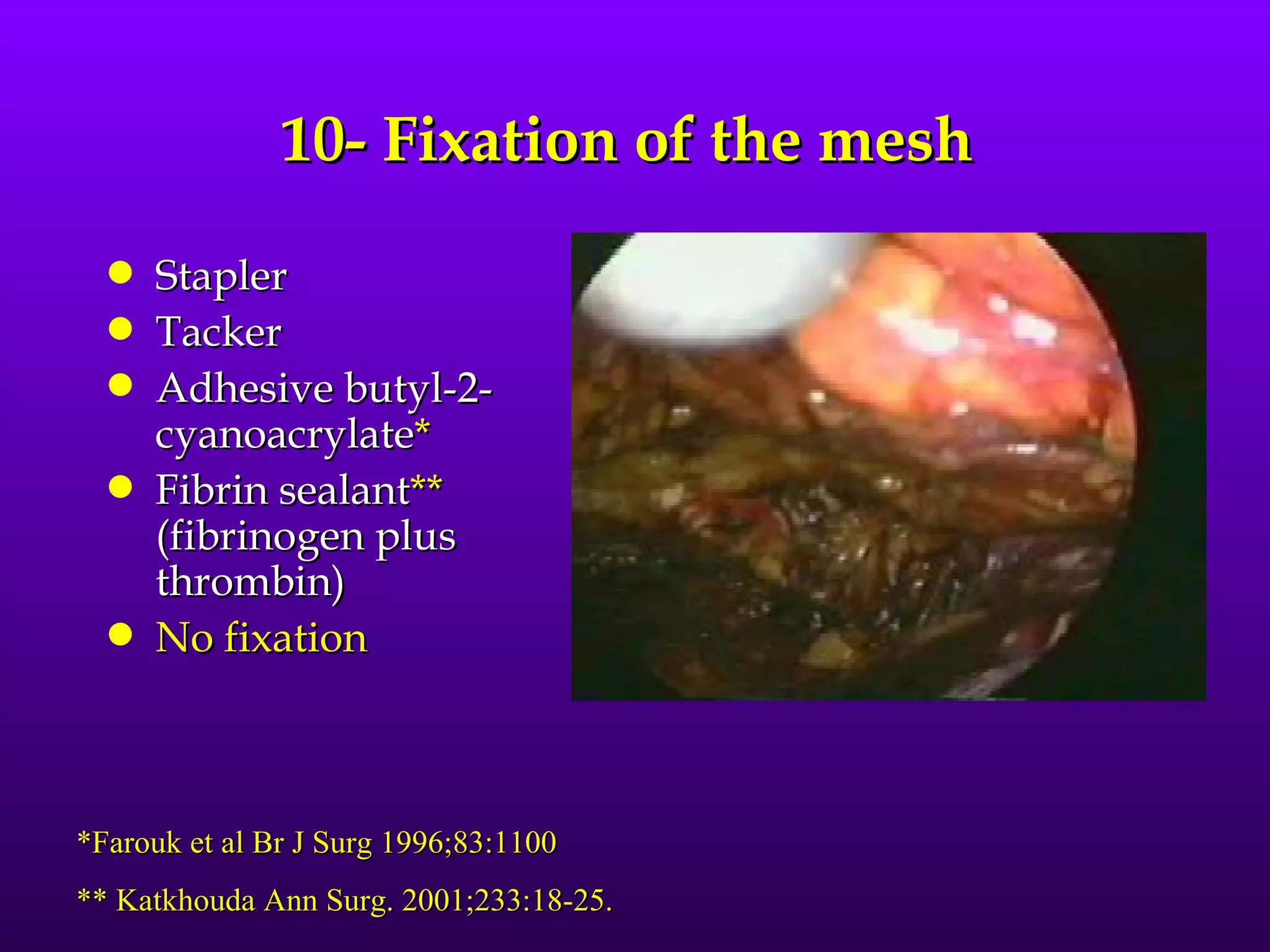 10- Fixation of the mesh
  q   Stapler
  q   Tacker
  q   Adhesive butyl-2-
      cyanoacrylate*
  q   Fibrin sealant**
      (fibrinogen plus
      thrombin)
  q   No fixation



*Farouk et al Br J Surg 1996;83:1100
** Katkhouda Ann Surg. 2001;233:18-25.
 