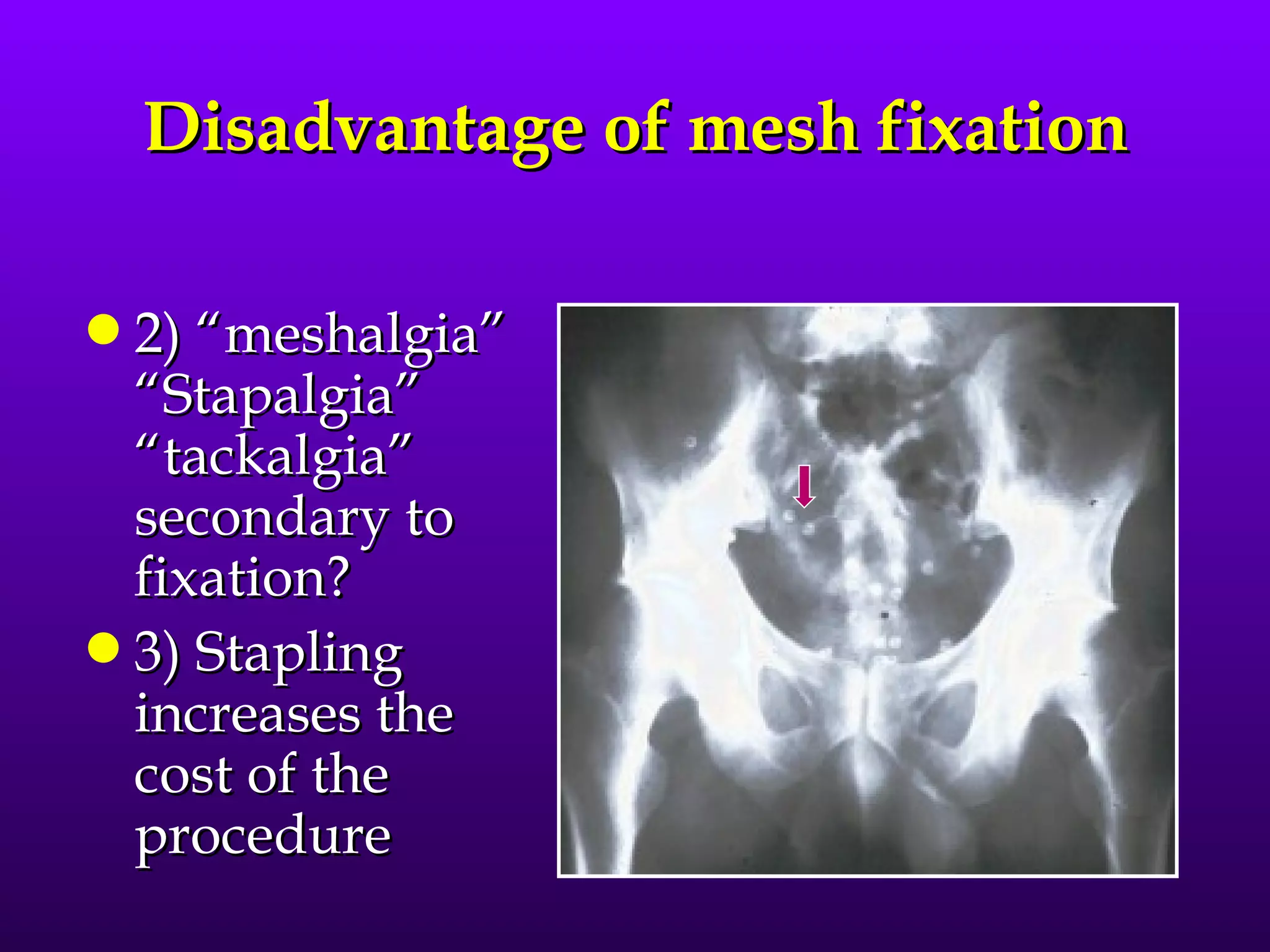 Disadvantage of mesh fixation

q 2) “meshalgia”
  “Stapalgia”
  “tackalgia”
  secondary to
  fixation?
q 3) Stapling
  increases the
  cost of the
  procedure
 