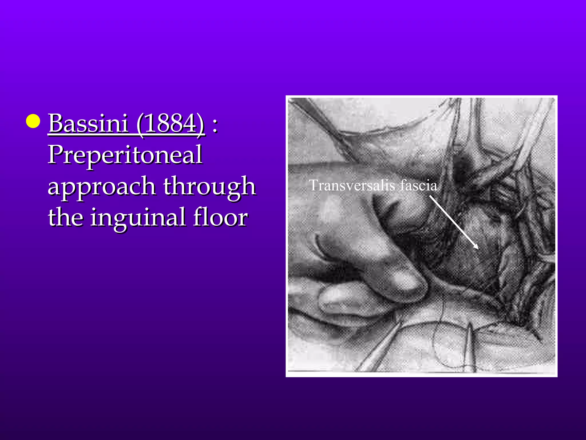 q   Bassini (1884) :
    Preperitoneal
    approach through     Transversalis fascia

    the inguinal floor
 