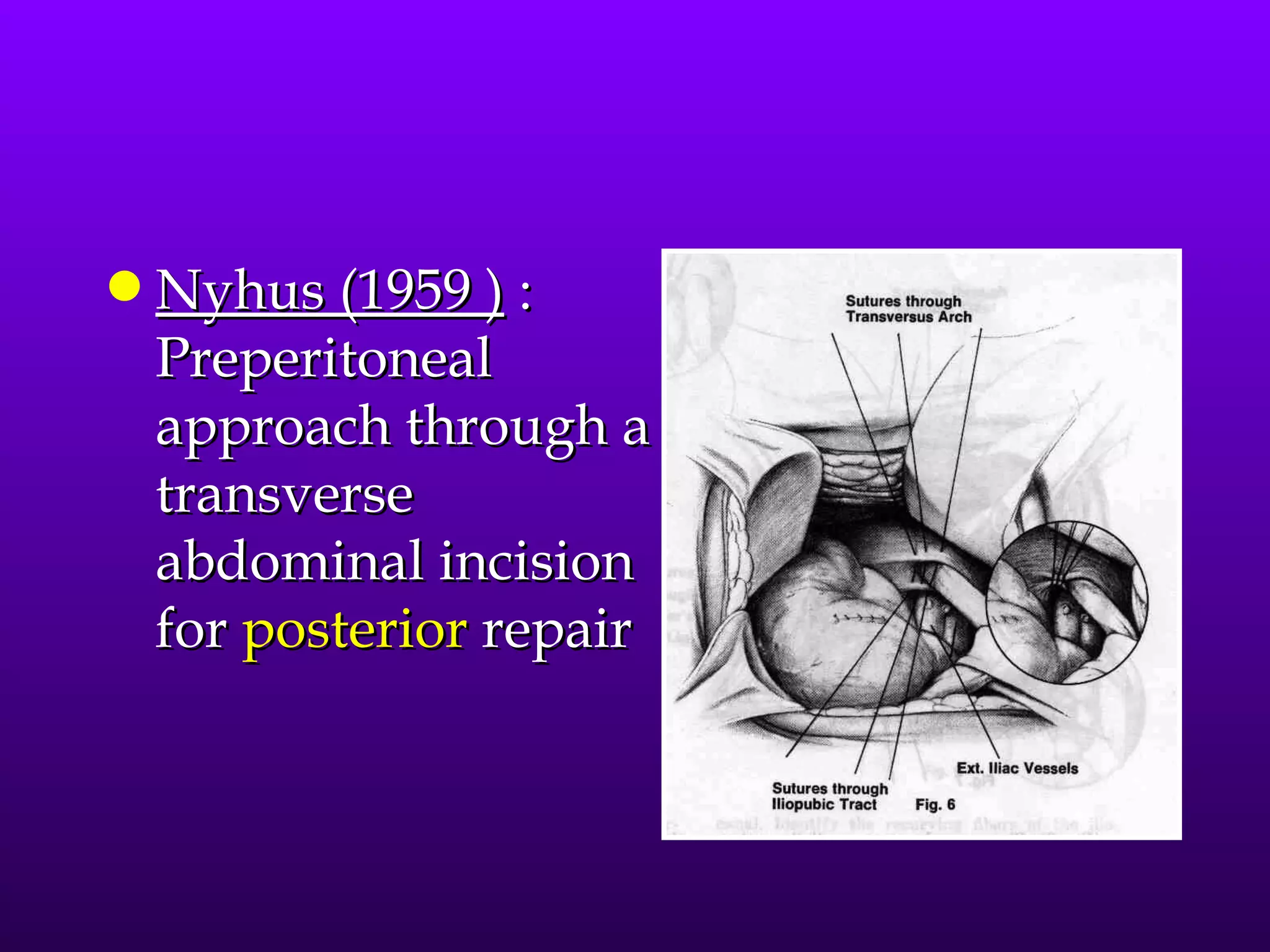 q   Nyhus (1959 ) :
    Preperitoneal
    approach through a
    transverse
    abdominal incision
    for posterior repair
 