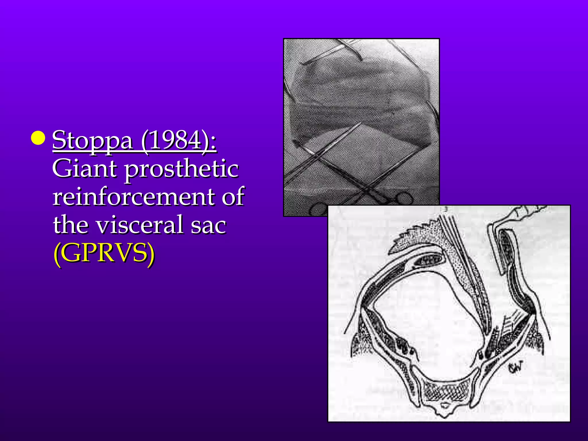 q   Stoppa (1984):
    Giant prosthetic
    reinforcement of
    the visceral sac
    (GPRVS)
 