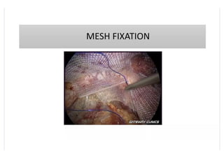 laparoscopic inguinal hernia repair and surgery | PPTX