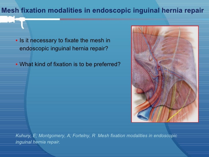 Laparoscopic Inguinal Hernia Repair Eminencebased or Evidencebased?