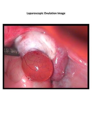 Laparoscopic Ovulation Image
 