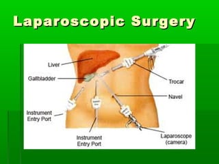 Laparoscopic Surgery

 