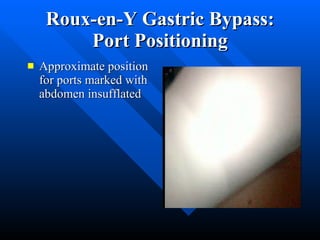 Roux-en-Y Gastric Bypass: Port Positioning Approximate position for ports marked with abdomen insufflated 