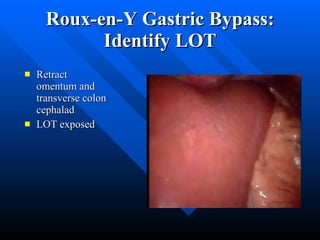 Roux-en-Y Gastric Bypass: Identify LOT Retract omentum and transverse colon cephalad LOT exposed 
