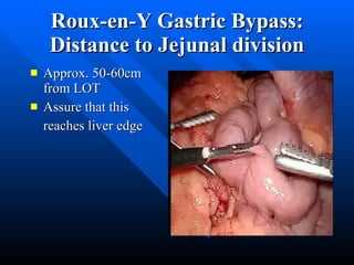 Roux-en-Y Gastric Bypass: Distance to Jejunal division Approx. 50-60cm from LOT Assure that this  reaches liver edge 