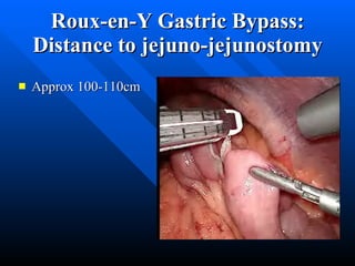 Roux-en-Y Gastric Bypass: Distance to jejuno-jejunostomy Approx 100-110cm 