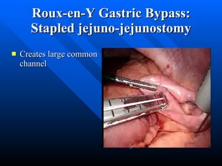 Roux-en-Y Gastric Bypass: Stapled jejuno-jejunostomy Creates large common channel 