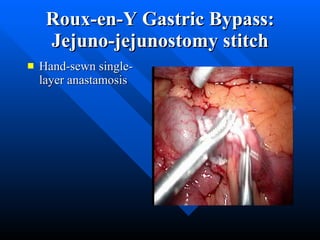 Roux-en-Y Gastric Bypass: Jejuno-jejunostomy stitch Hand-sewn single-layer anastamosis 