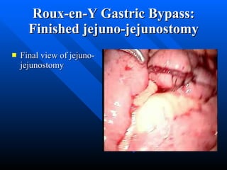 Roux-en-Y Gastric Bypass: Finished jejuno-jejunostomy Final view of jejuno-jejunostomy 