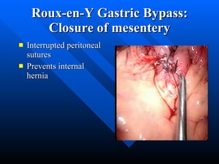 Roux-en-Y Gastric Bypass: Closure of mesentery Interrupted peritoneal sutures  Prevents internal hernia 